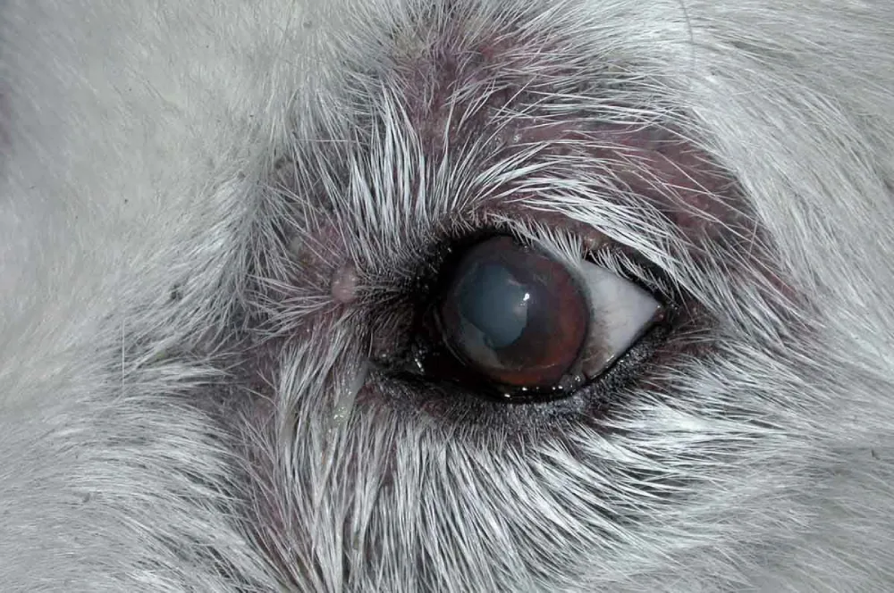 Cataract